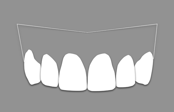 Blanqueamiento dental